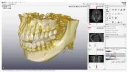 デジタルレントゲン